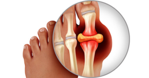 Gout Attack Image