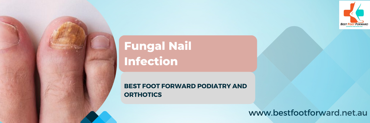 Read more about the article Fungal Nail Infection